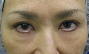 目の下のたるみ、目のくまでお悩みの方、切らずに完璧に解決します。TCB-R法　手術直後　症例写真